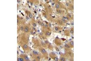 Immunohistochemistry analysis in formalin fixed and paraffin embedded human hepatocarcinoma reacted with HPR Antibody (Center) followed by peroxidase conjugation of the secondary antibody and DAB staining.