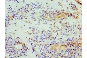 Immunohistochemistry of paraffin-embedded human breast cancer using ABIN7152008 at dilution of 1:100 (Stomatin Antikörper  (AA 55-288))