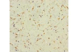 Immunohistochemistry of paraffin-embedded human colon cancer using ABIN7165526 at dilution of 1:100 (Protein FAM60A (SINHCAF) (AA 1-221) Antikörper)