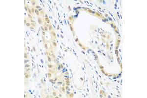 Immunohistochemistry of paraffin-embedded human stomach cancer using POLR2E antibody. (POLR2E Antikörper)