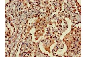 Immunohistochemistry of paraffin-embedded human lung cancer using ABIN7161610 at dilution of 1:100 (NINJ1 Antikörper  (AA 1-80))