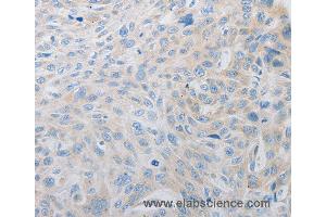 Immunohistochemistry of Human esophagus cancer using PDX1 Polyclonal Antibody at dilution of 1:30