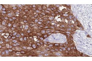 ABIN6277050 at 1/100 staining Human Head and neck cancer tissue by IHC-P. (CD247 Antikörper  (C-Term))