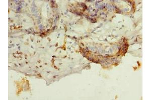 Immunohistochemistry of paraffin-embedded human breast cancer using ABIN7145275 at dilution of 1:100 (BATF Antikörper  (AA 1-125))