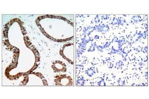Immunohistochemical analysis of paraffin-embedded human breast carcinoma tissue, using 14-3-3 ζ (Ab-58) antibody (E021188). (14-3-3 zeta Antikörper)