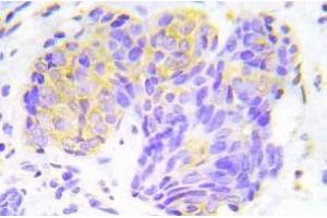 Immunohistochemistry (IHC) analyzes of p-4E-BP1 antibody in paraffin-embedded human lung adenocarcinoma tissue. (eIF4EBP1 Antikörper  (pThr45))