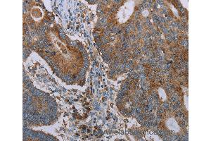 Immunohistochemistry of Human thyroid cancer using CYP7A1 Polyclonal Antibody at dilution of 1:20 (CYP7A1 Antikörper)