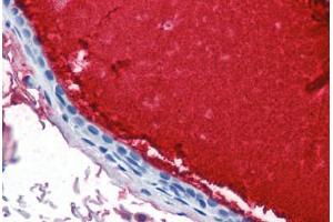Human Breast, Ductal with Secretion (formalin-fixed, paraffin-embedded) stained with LTF antibody ABIN337355 at 10 ug/ml followed by biotinylated anti-mouse IgG secondary antibody ABIN481714, alkaline phosphatase-streptavidin and chromogen. (Lactoferrin Antikörper)