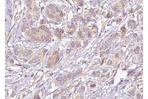 ABIN6274661 at 1/100 staining Human breast cancer tissue by IHC-P. (CYP4Z1 Antikörper)