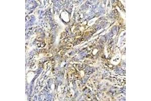 Immunohistochemistry analysis of human colon cancer tissue using HSP70 mAb (C92F3A-5) at a dilution of 1:50. (HSP70 Antikörper)