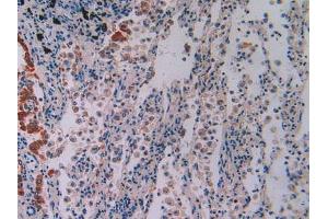 IHC-P analysis of Human Lung Cancer Tissue, with DAB staining. (IFI16 Antikörper  (AA 465-671))