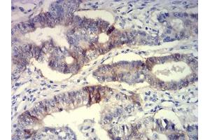 Immunohistochemical analysis of paraffin-embedded lung cancer tissues using CD239 mouse mAb with DAB staining.