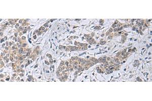 Immunohistochemistry of paraffin-embedded Human colorectal cancer tissue using SLC4A3 Polyclonal Antibody at dilution of 1:35(x200) (SLC4A3 Antikörper)