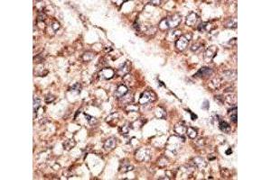 IHC analysis of FFPE human hepatocarcinoma tissue stained with the BMP3 antibody (BMP3 Antikörper  (AA 8-36))