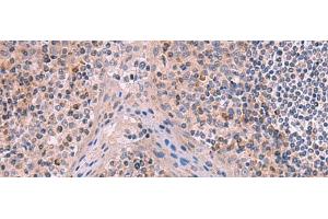 Immunohistochemistry of paraffin-embedded Human tonsil tissue using ITIH4 Polyclonal Antibody at dilution of 1:50(x200) (ITIH4 Antikörper)
