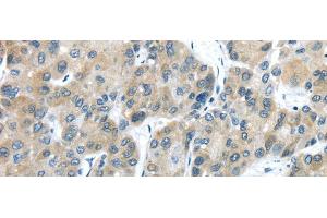 Immunohistochemistry of paraffin-embedded Human liver cancer using TXNDC5 Polyclonal Antibody at dilution of 1/40 (TXNDC5 Antikörper)