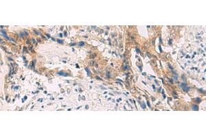Immunohistochemistry of paraffin-embedded Human cervical cancer tissue using PCYT2 Polyclonal Antibody at dilution of 1:55(x200) (PCYT2 Antikörper)