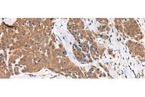 Immunohistochemistry of paraffin-embedded Human thyroid cancer tissue using CHAMP1 Polyclonal Antibody at dilution of 1:40(x200) (ZNF828 Antikörper)
