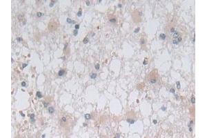 Detection of OAT in Human Glioma Tissue using Polyclonal Antibody to Ornithine Aminotransferase (OAT)