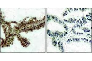 Immunohistochemistry (IHC) image for anti-V-Akt Murine Thymoma Viral Oncogene Homolog 1/2 (AKT1/2) (pThr308) antibody (ABIN2888353) (AKT1/2 Antikörper  (pThr308))