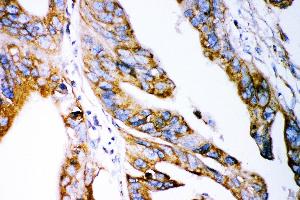 Anti- Claudin 2 antibody, IHC(P) IHC(P): Human Intestinal Cancer Tissue