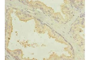 Immunohistochemistry of paraffin-embedded human prostate cancer using ABIN7164401 at dilution of 1:100 (SLC7A14 Antikörper  (AA 676-771))