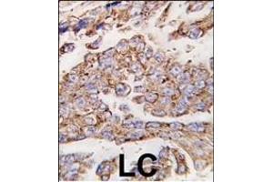 Formalin-fixed and paraffin-embedded human lung carcinoma tissue reacted with *LP1 antibody (N-term) (ABIN388566 and ABIN2849737) , which was peroxidase-conjugated to the secondary antibody, followed by DAB staining. (LAMP1 Antikörper  (N-Term))