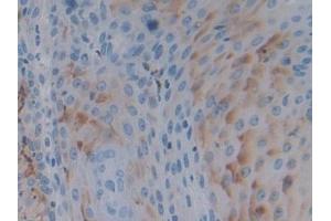 Detection of PTPRH in Human Skin cancer Tissue using Polyclonal Antibody to Protein Tyrosine Phosphatase Receptor Type H (PTPRH) (PTPRH Antikörper  (AA 844-1096))