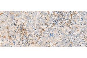 Immunohistochemistry of paraffin-embedded Human cervical cancer tissue using FECH Polyclonal Antibody at dilution of 1:55(x200) (FECH Antikörper)