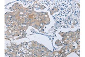 The image on the left is immunohistochemistry of paraffin-embedded Human breast cancer tissue using ABIN7189583(ABCB9 Antibody) at dilution 1/15, on the right is treated with synthetic peptide. (ABCB9 Antikörper)