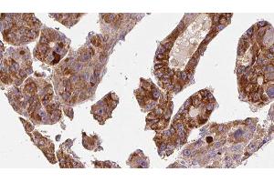 ABIN6277215 at 1/100 staining Human liver cancer tissue by IHC-P. (P2RY6 Antikörper  (C-Term))