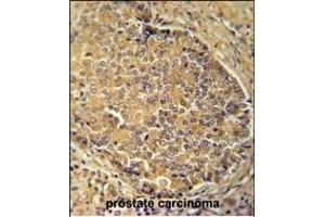 IGSF1 antibody (C-term) (ABIN654689 and ABIN2844381) immunohistochemistry analysis in formalin fixed and paraffin embedded human prostate carcinoma followed by peroxidase conjugation of the secondary antibody and DAB staining.