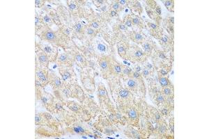 Immunohistochemistry of paraffin-embedded human liver cancer using COX1/COX1/PTGS1 antibody (ABIN6130124, ABIN6146413, ABIN6146414 and ABIN6223187) at dilution of 1:100 (40x lens). (PTGS1 Antikörper  (AA 1-180))