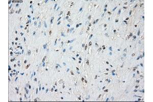 Immunohistochemical staining of paraffin-embedded Adenocarcinoma of colon tissue using anti-BUB1Bmouse monoclonal antibody. (BUB1B Antikörper)