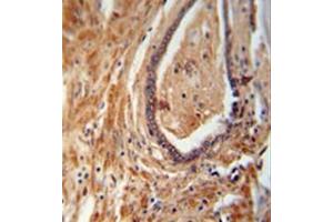 Immunohistochemistry analysis in formalin fixed and paraffin embedded human prostate carcinoma reacted with NDUFAF1 Antibody (C-term) followed which was peroxidase conjugated to the secondary antibody and followed by DAB staining.