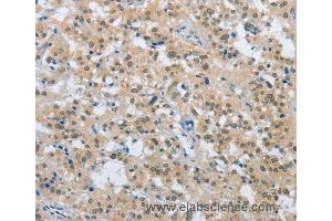 Immunohistochemistry of Human thyroid cancer using ENTPD5 Polyclonal Antibody at dilution of 1:20 (ENTPD5 Antikörper)