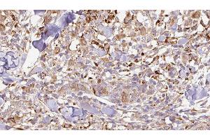 ABIN6276952 at 1/100 staining Human Melanoma tissue by IHC-P. (CNTF Antikörper  (C-Term))