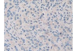 Detection of PDHX in Human Prostate cancer Tissue using Polyclonal Antibody to Pyruvate Dehydrogenase Complex Component X (PDHX)