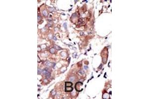 Formalin-fixed and paraffin-embedded human cancer tissue reacted with the primary antibody, which was peroxidase-conjugated to the secondary antibody, followed by AEC staining. (MUSK Antikörper  (C-Term))