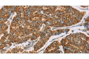Immunohistochemistry of paraffin-embedded Human breast cancer tissue using DLL4 Polyclonal Antibody at dilution 1:40 (DLL4 Antikörper)