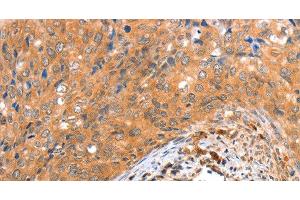 Immunohistochemistry of paraffin-embedded Human cervical cancer tissue using ACOX3 Polyclonal Antibody at dilution 1:35 (ACOX3 Antikörper)