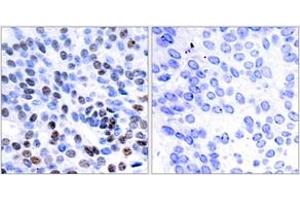 Immunohistochemistry analysis of paraffin-embedded human breast carcinoma tissue, using JunB (Ab-259) Antibody. (JunB Antikörper  (AA 226-275))