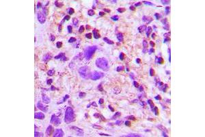 Immunohistochemical analysis of TGF beta 2 staining in human lung cancer formalin fixed paraffin embedded tissue section. (TGFB2 Antikörper  (C-Term))