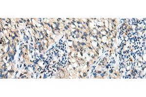 Immunohistochemistry of paraffin-embedded Human lung cancer tissue using DHRSX Polyclonal Antibody at dilution of 1:30(x200) (DHRSX Antikörper)
