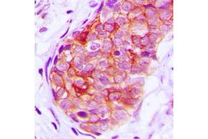 Immunohistochemical analysis of GRK6 staining in human breast cancer formalin fixed paraffin embedded tissue section.