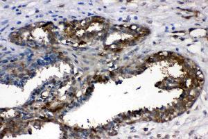 LDHA was detected in paraffin-embedded sections of human mammary cancer tissues using rabbit anti- LDHA Antigen Affinity purified polyclonal antibody (Catalog # ) at 1 µg/mL. (Lactate Dehydrogenase A Antikörper  (AA 2-106))