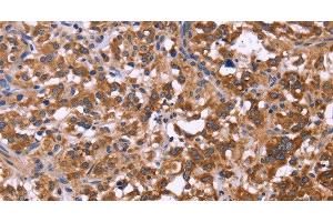 Immunohistochemistry of paraffin-embedded Human thyroid cancer tissue using FBXW7 Polyclonal Antibody at dilution 1:40 (FBXW7 Antikörper)