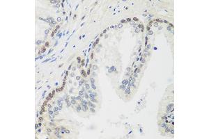 Immunohistochemistry of paraffin-embedded human prostate using MDC1 antibody (ABIN5974564) at dilution of 1/100 (40x lens). (MDC1 Antikörper)