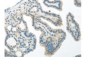 The image on the left is immunohistochemistry of paraffin-embedded Human thyroid cancer tissue using ABIN7193059(WNT10A Antibody) at dilution 1/30, on the right is treated with synthetic peptide. (Protein Wnt-1 (WNT1.L) Antikörper)
