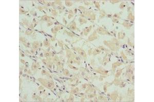 Immunohistochemistry of paraffin-embedded human gastric cancer using ABIN7149046 at dilution of 1:100 (CHIC2 Antikörper  (AA 1-165))